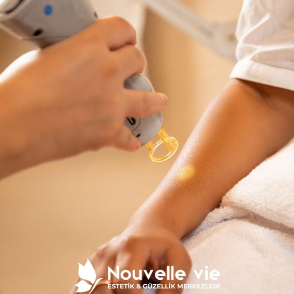 Lazer Epilasyon Nedir?