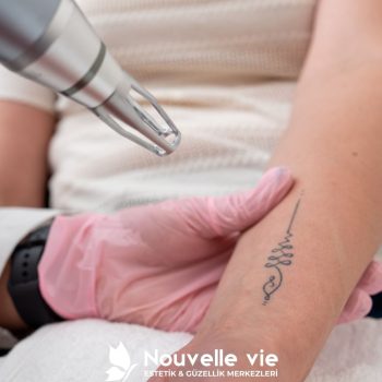 Lazerle Dövme Silme