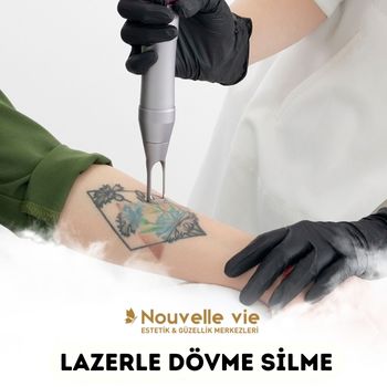 Lazerle Dövme Silme